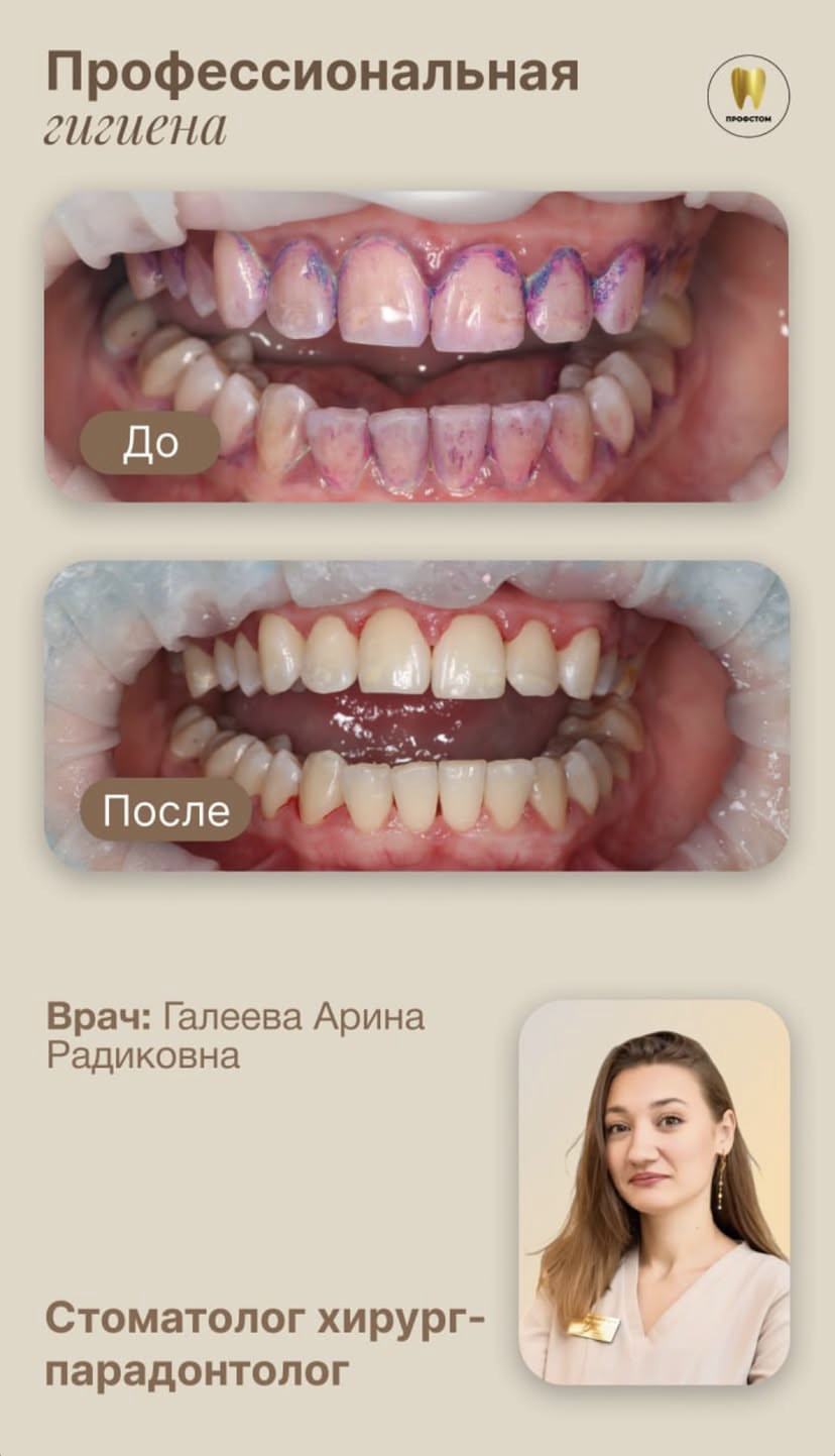Профессиональная гигиена — до и после