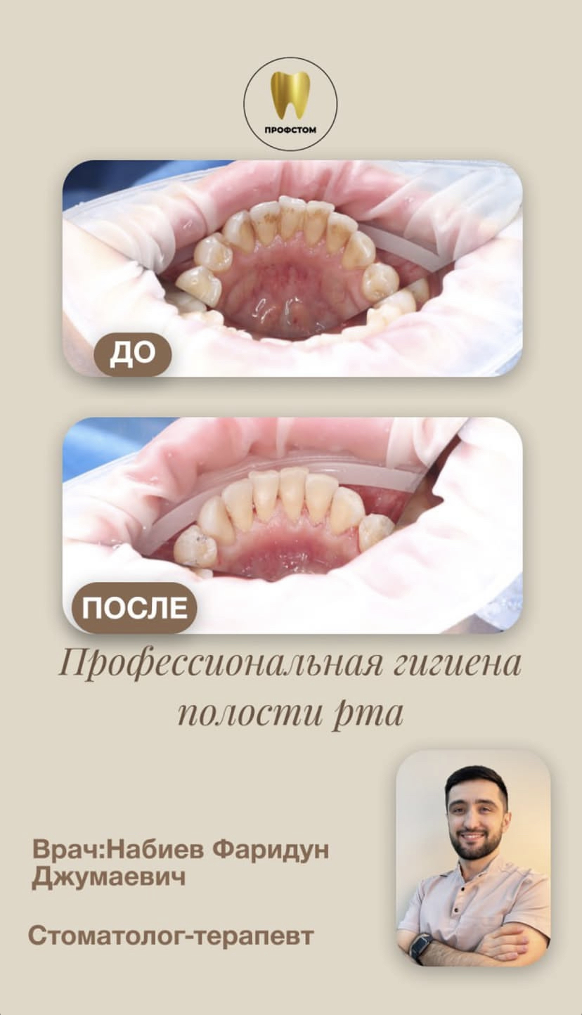 Профессиональная гигиена — до и после