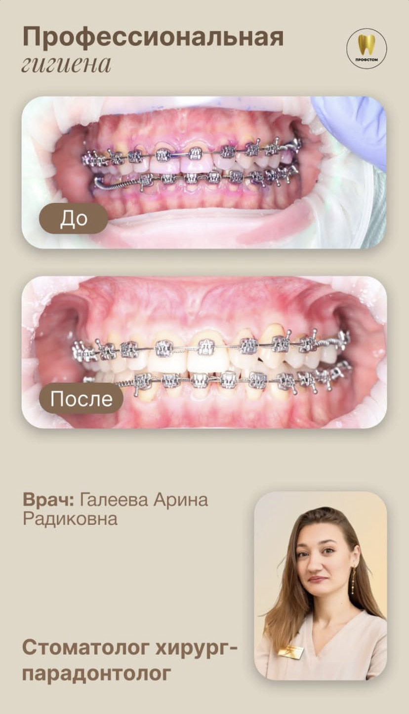 Профессиональная гигиена — до и после